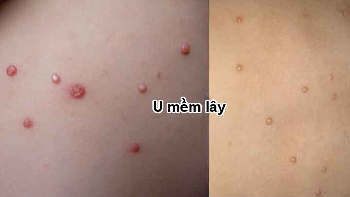 U mềm lây - Hình ảnh minh họa